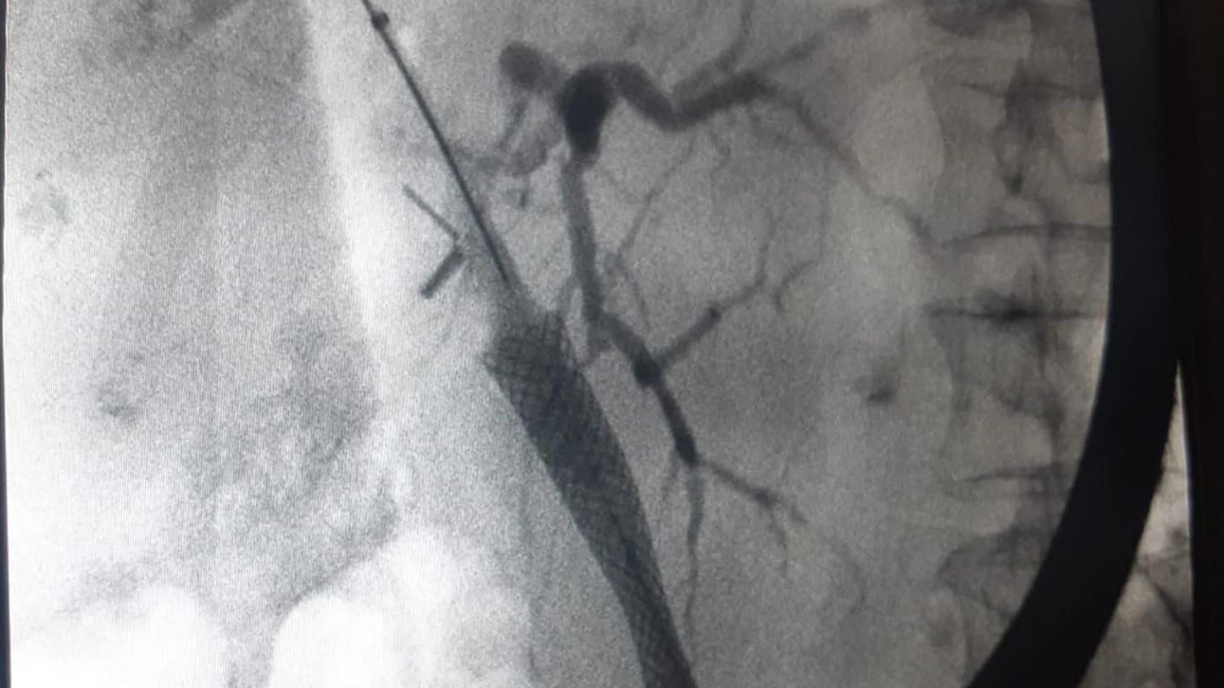 Colangiopancreatografia Retrógrada Endoscópica
